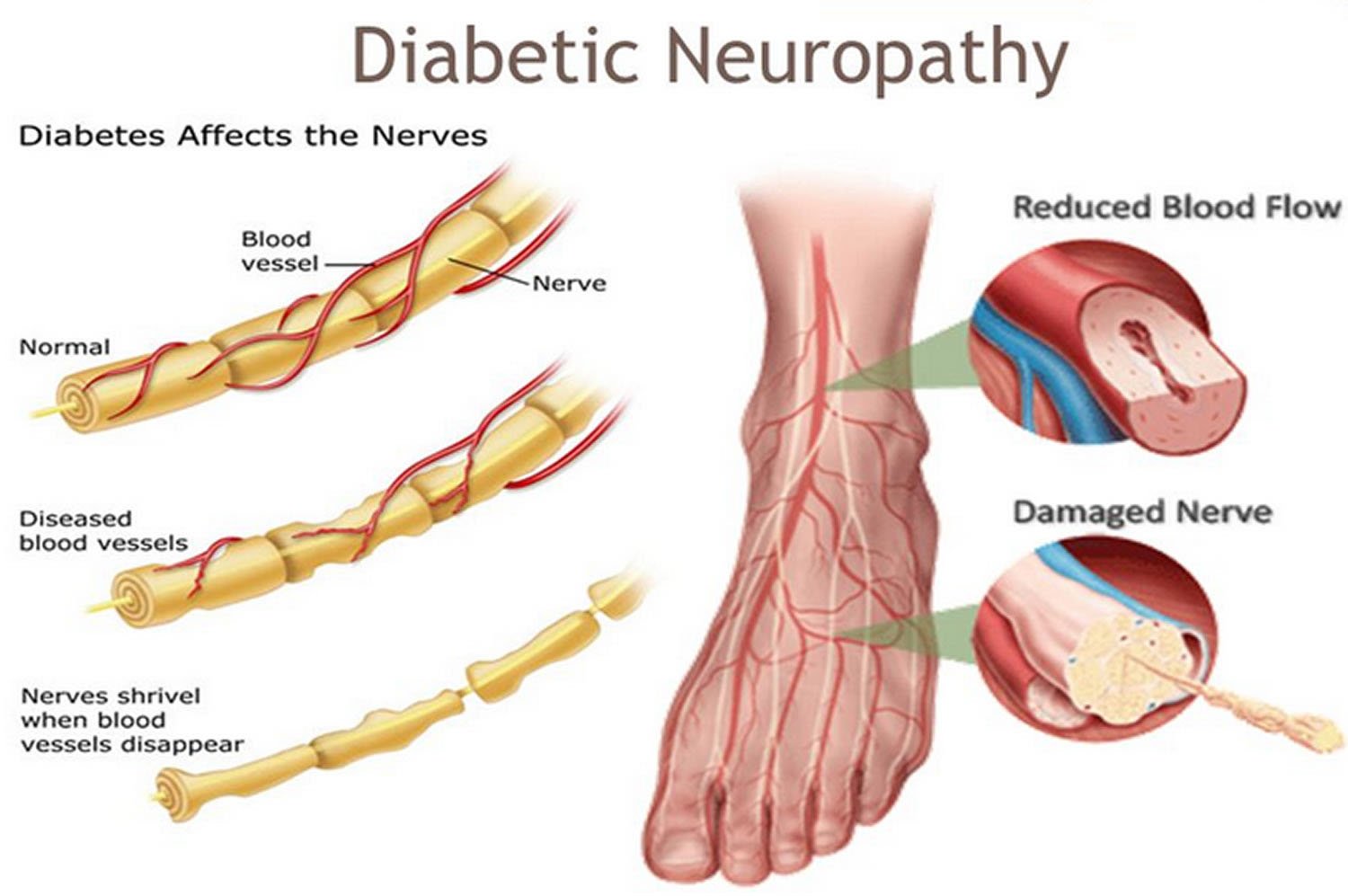 Diabetic neuropathy treatment near me